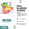 GALLSTONES